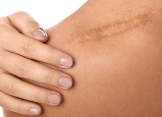 Cicatricile, semnele care ne leaga de trecut