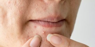 Cosuri cu puroi: de ce ies si cum sa le vindeci