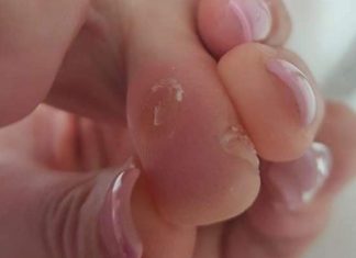 Remedii la domiciliu pentru a elimina batatura ”ochi de gaina” de pe picior